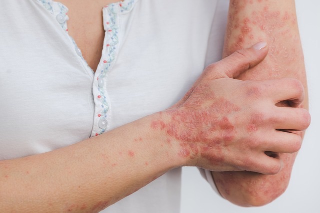 Suppression de l'eczéma par le magnétisme